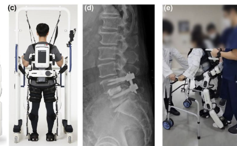 Robot-Assisted Gait Rehabilitation for Spinal Surgery Patients Improves Daily Function by 39%